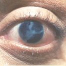 Iris Reconstructive Lens